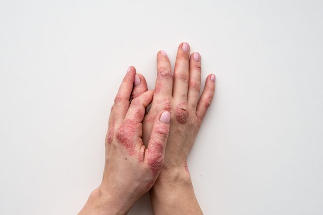 Psoriasis skin. Closeup of rash and scaling on the patient's skin. The concept of chronic disease treatment. Dermatological problems. Hard, horny and cracked skin in woman's hands. Dry skin. Isolated