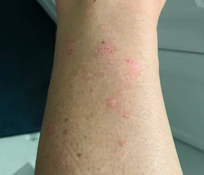 Jennifer Kerner psoriasis