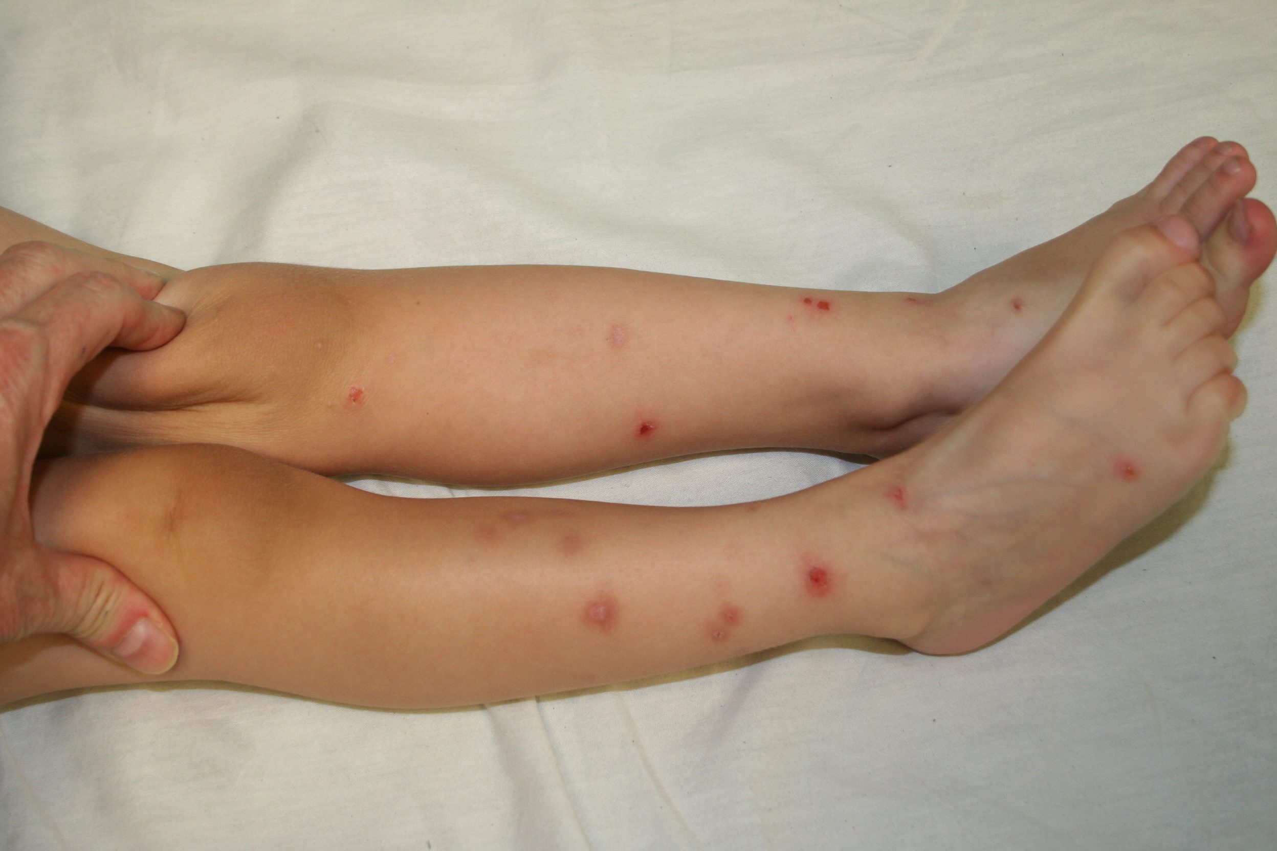 flea bites on small child's legs