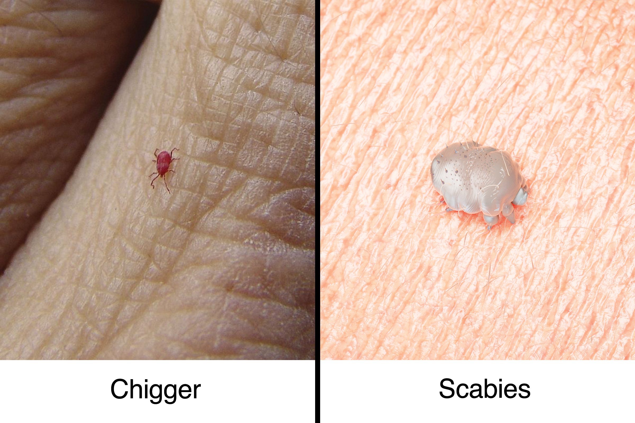 chigger vs scabies mites