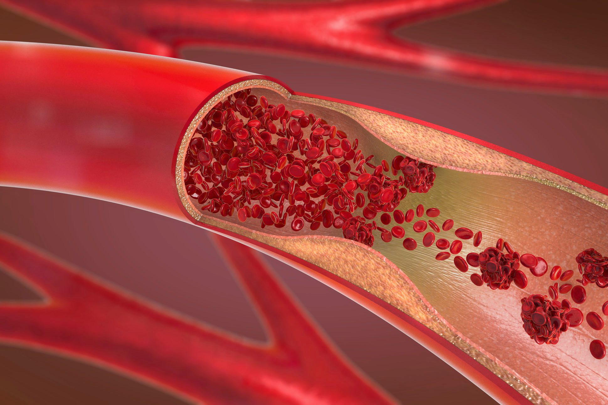 Arteriosclerosis, illustration