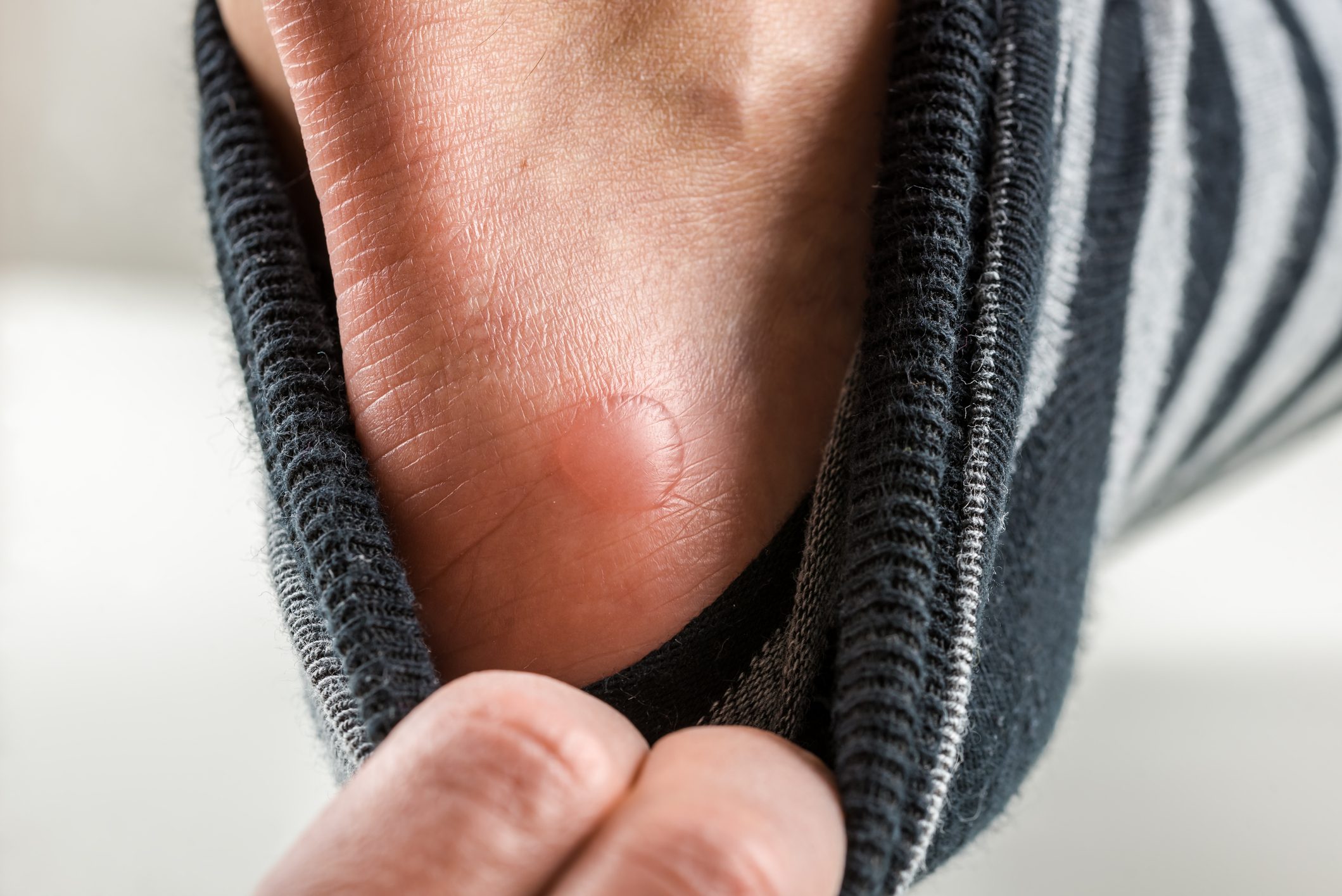 friction blister on heel