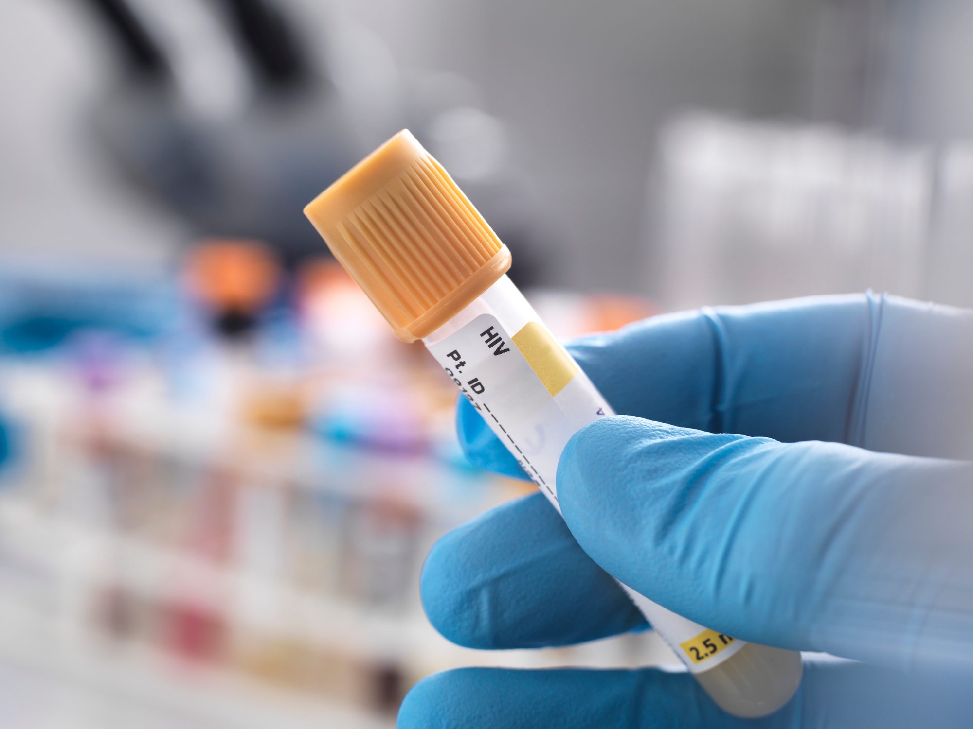 Medical technician preparing a sample for HIV testing