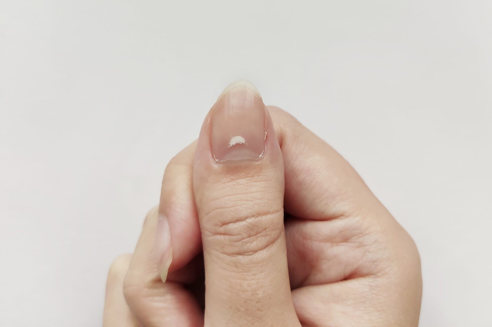 White Spots on Nail isolated on white background. Disease leuconychia