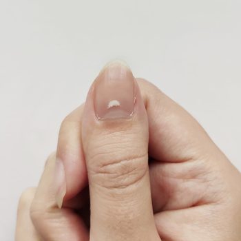 White Spots on Nail isolated on white background. Disease leuconychia