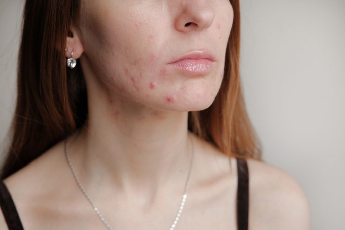 Woman with problem skin. Teen acne on young skin. Tools for removing acne.