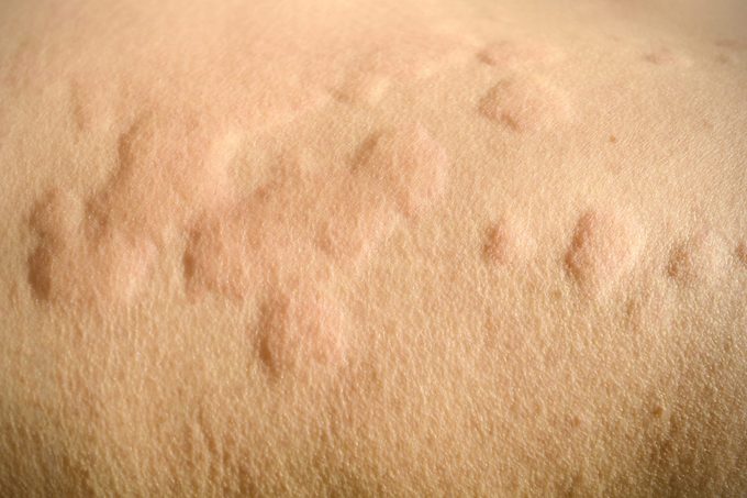 Urticaria, Allergic skin reaction.