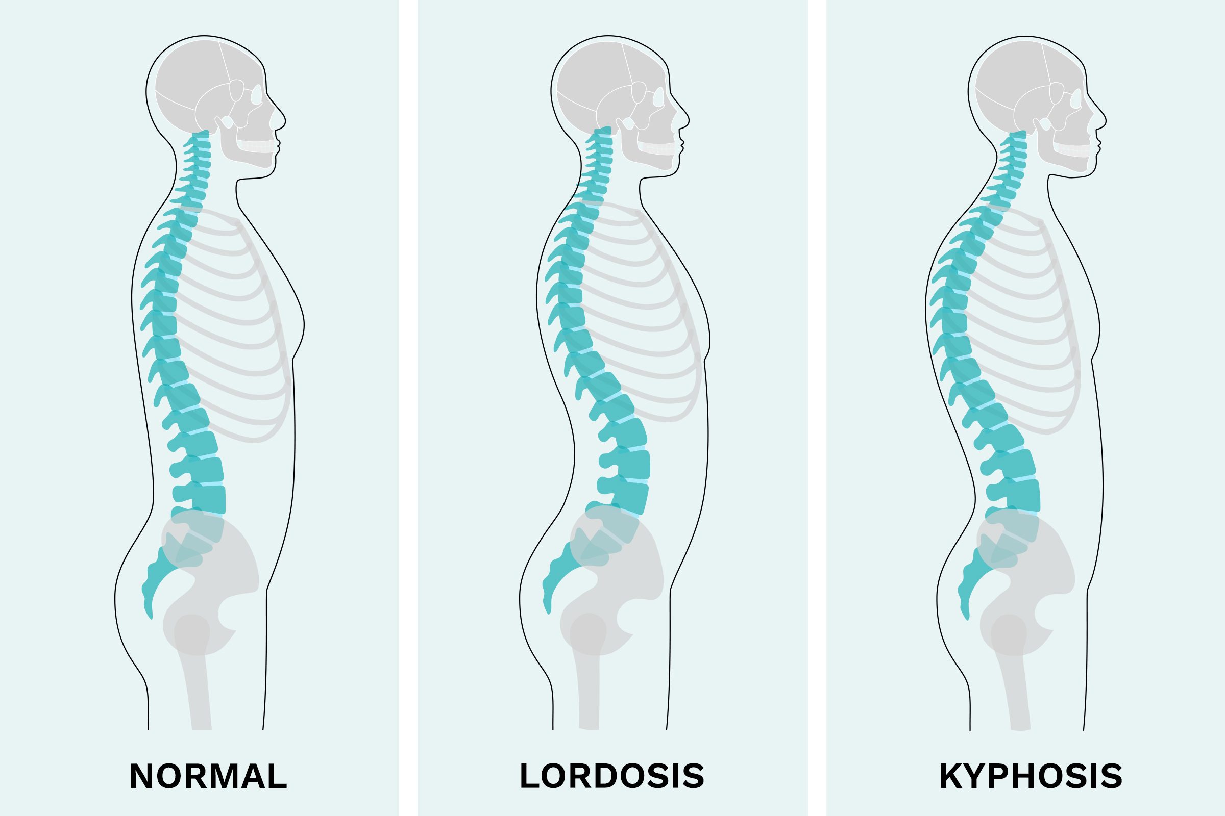 Lordosis And Kyphosis Illustration1