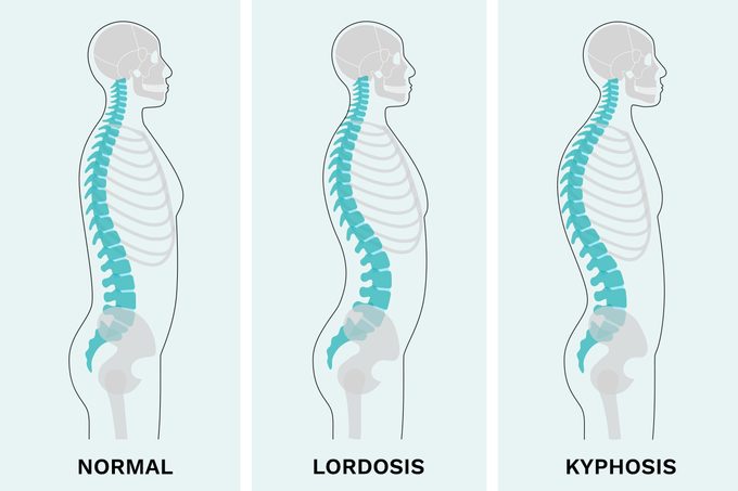 Lordosis And Kyphosis Illustration1