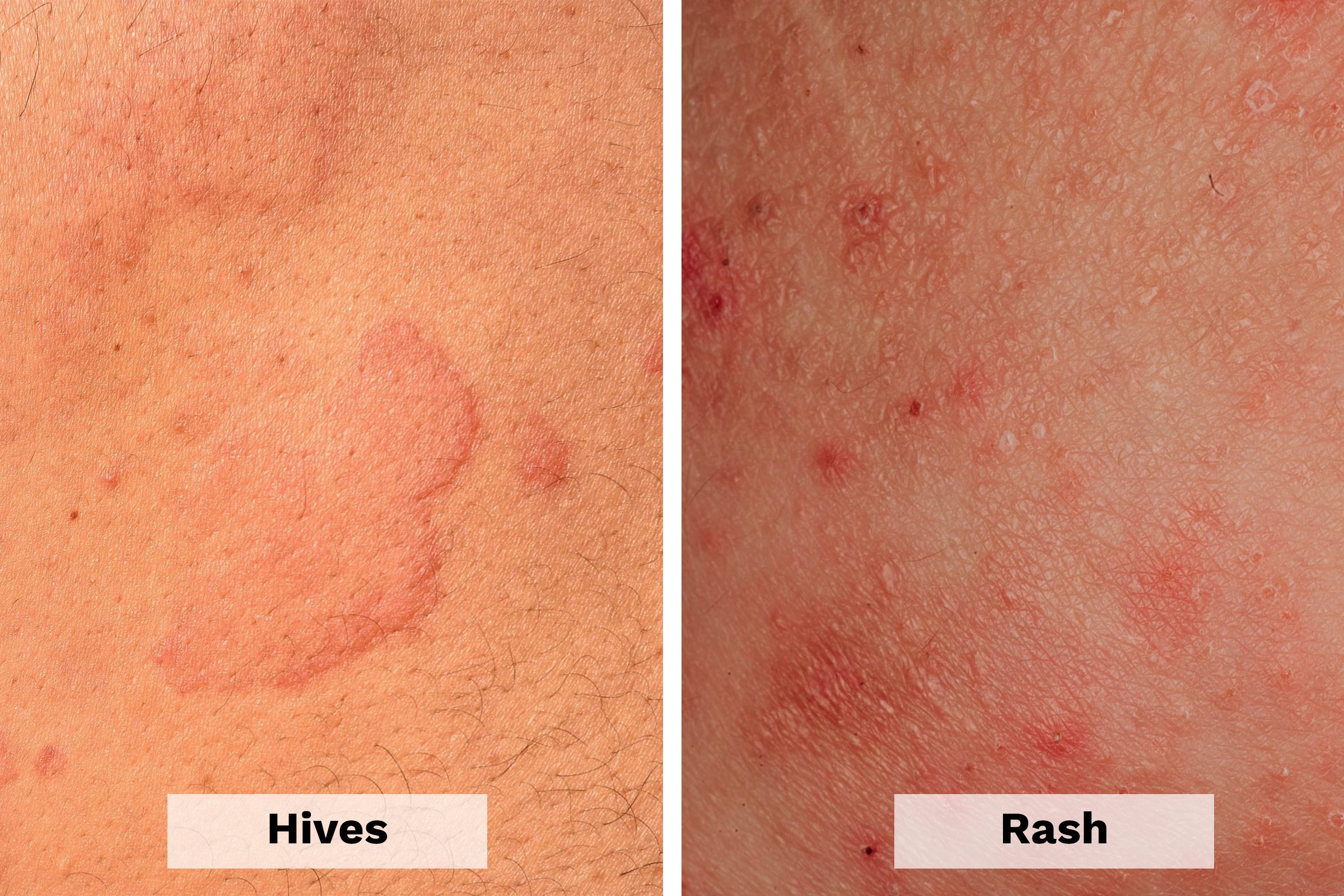 Hives Vs Rash