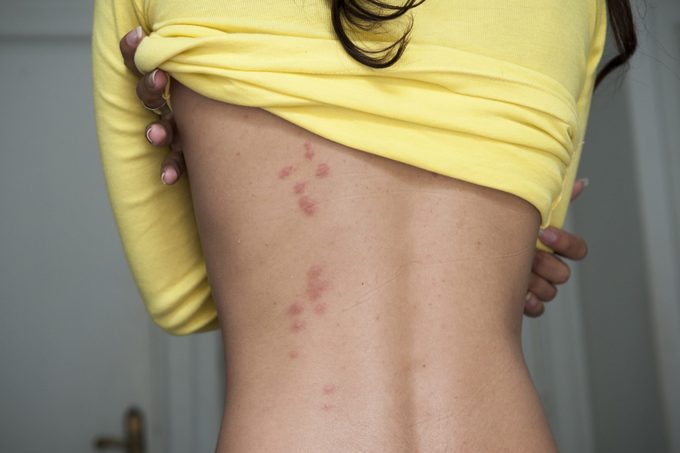 Bedbug bites in hotel room