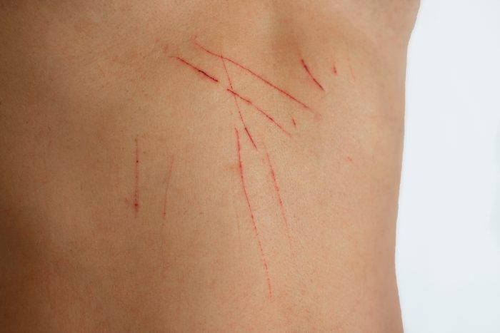 scratch marks on skin close up