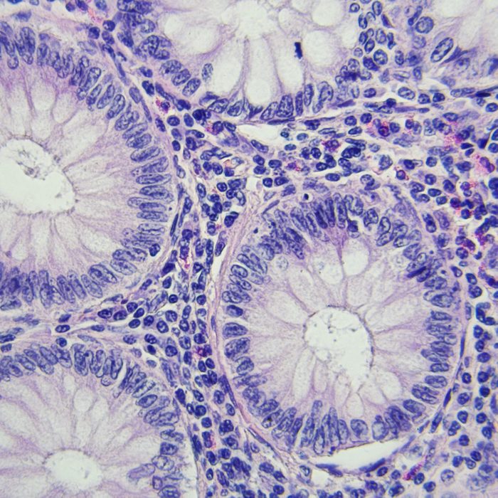 Colon cancer microscopic photography, magnification x400