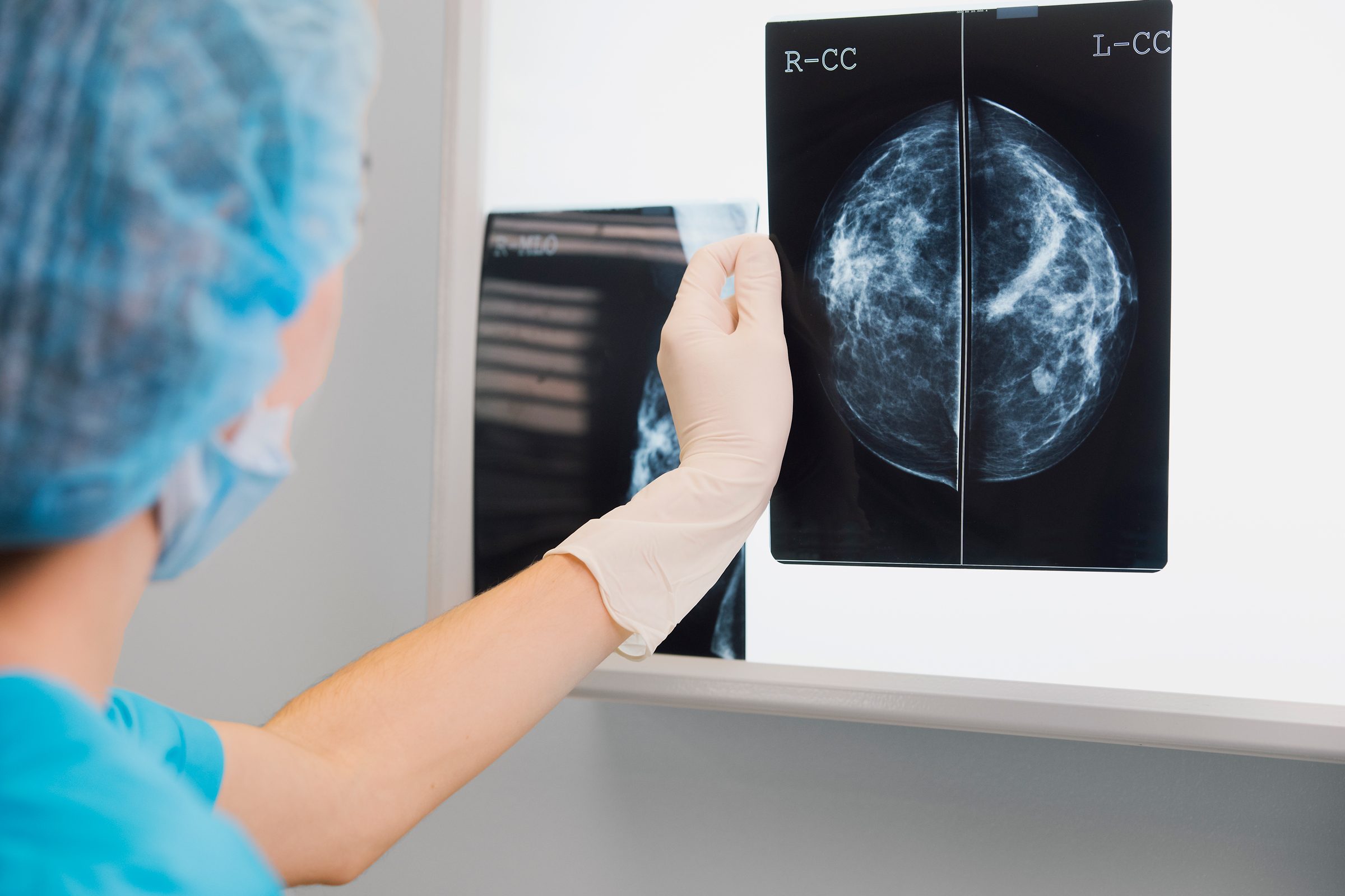 woman doctor or nurse in surgery outfit is holding a mammogram in front of x-ray illuminator