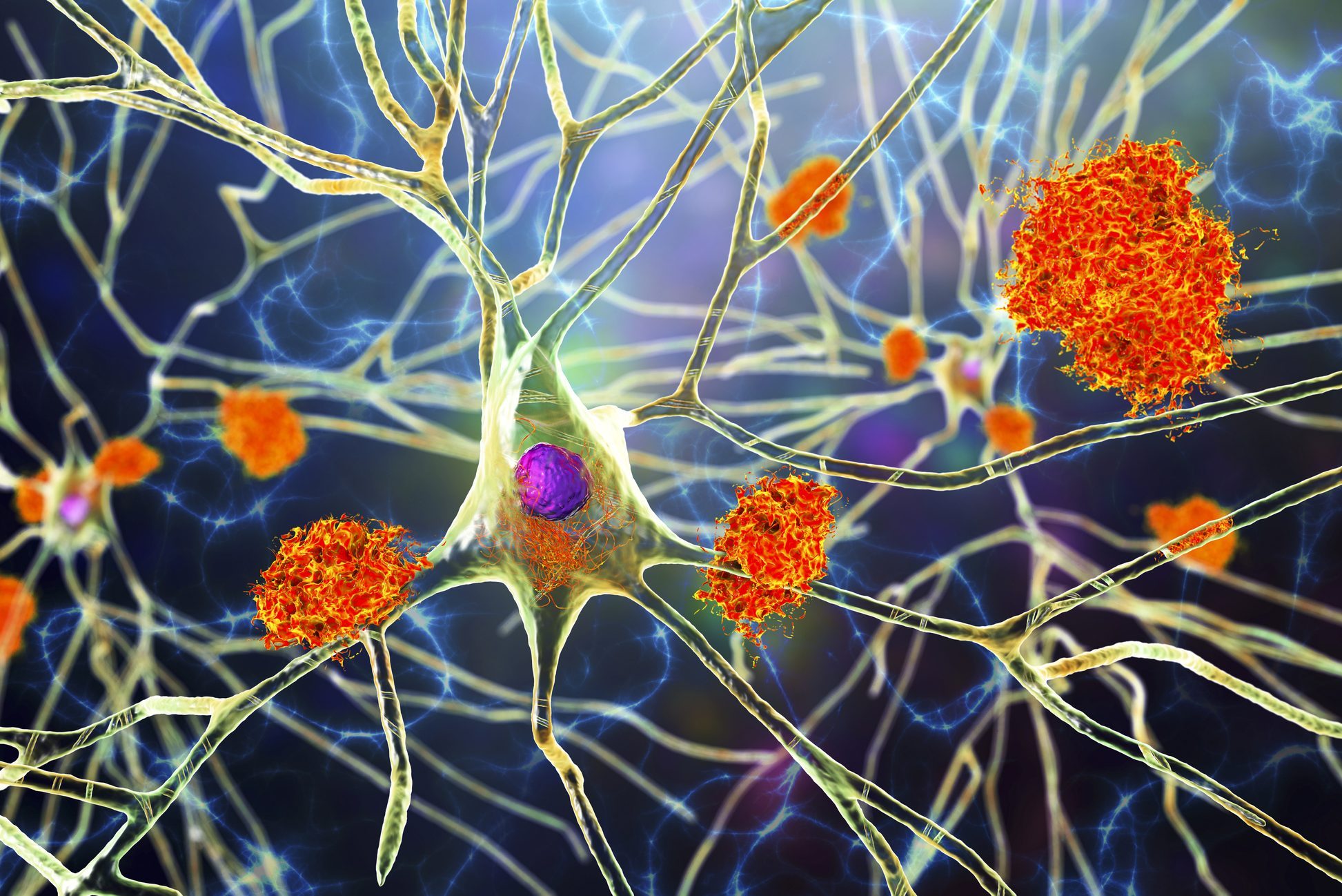 Nerve cells affected by Alzheimer's disease, illustration