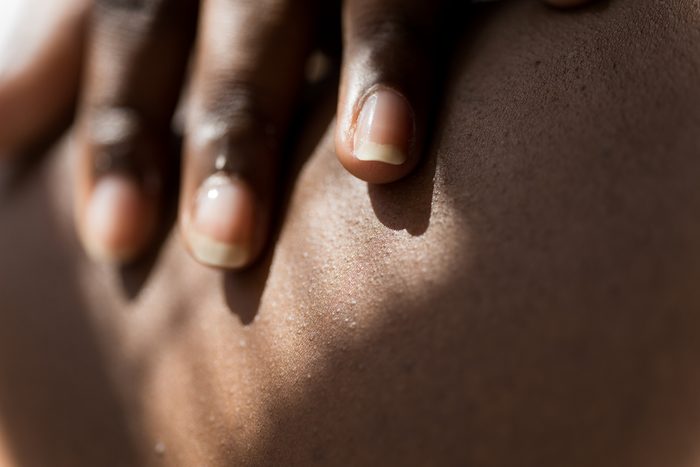 Close-up view of woman applying acne cream to her body at home.