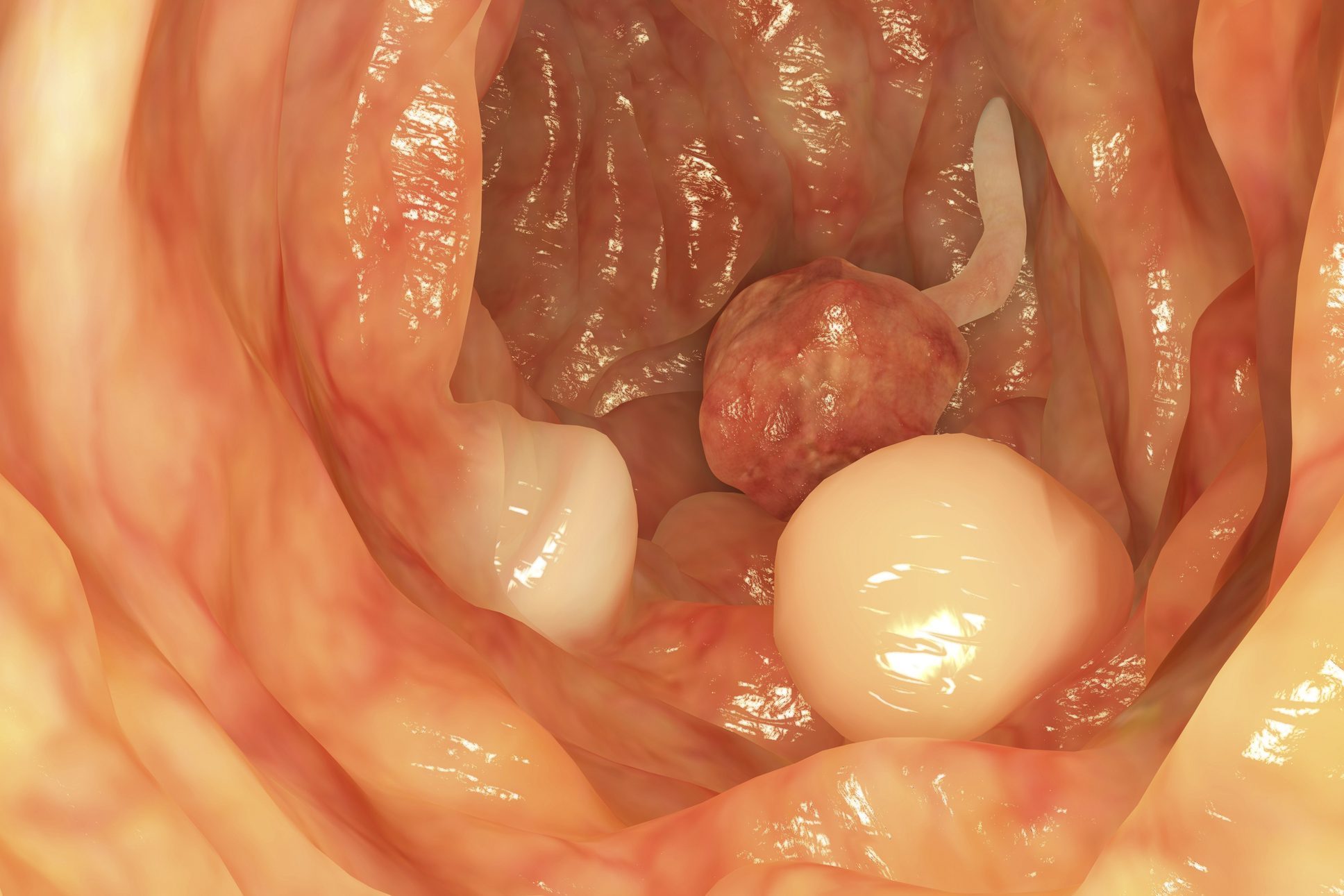 Polyps in colon, artwork