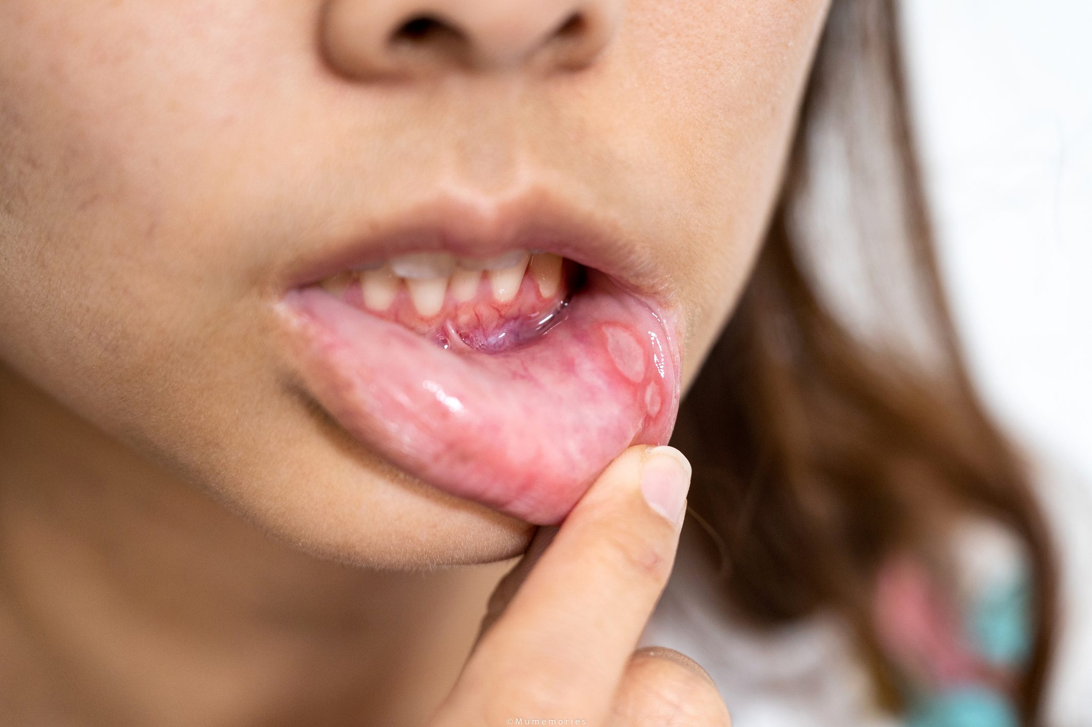 Asian woman have Aphthous ulcer or Canker sore on mouth at lip