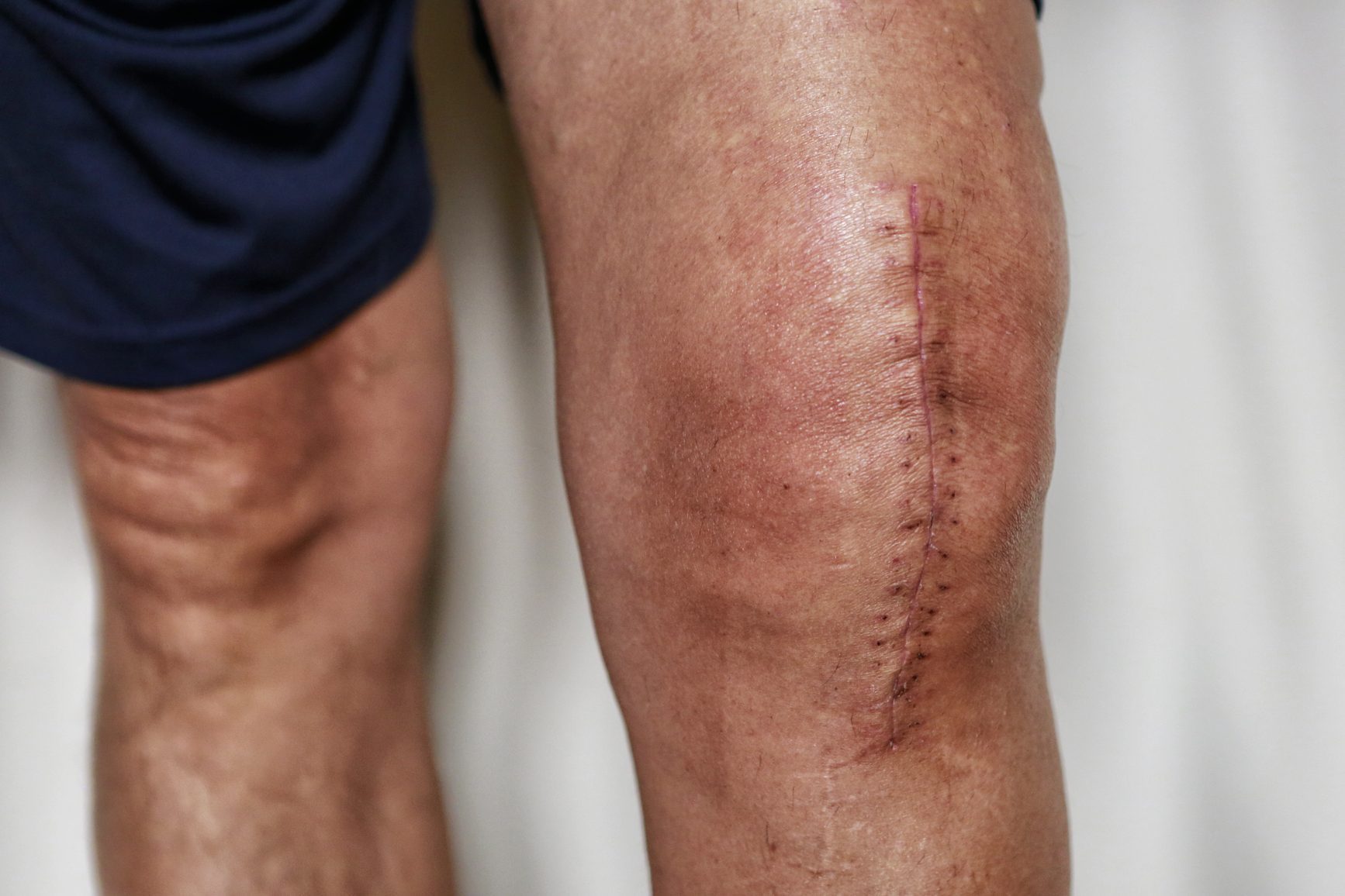 Painful scar after knee surgery