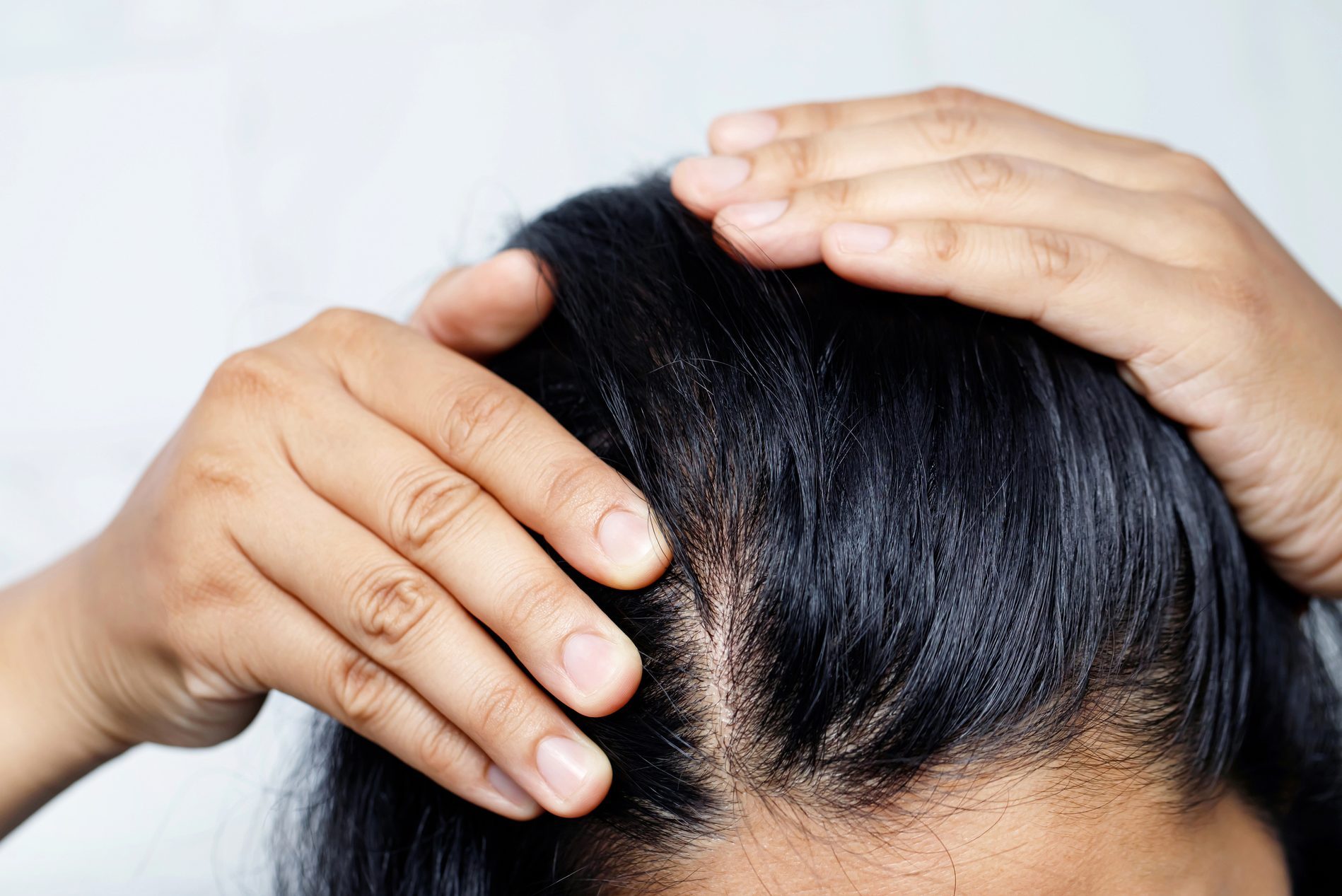 A woman with hair loss, she's allergic to shampoo and conditioner.