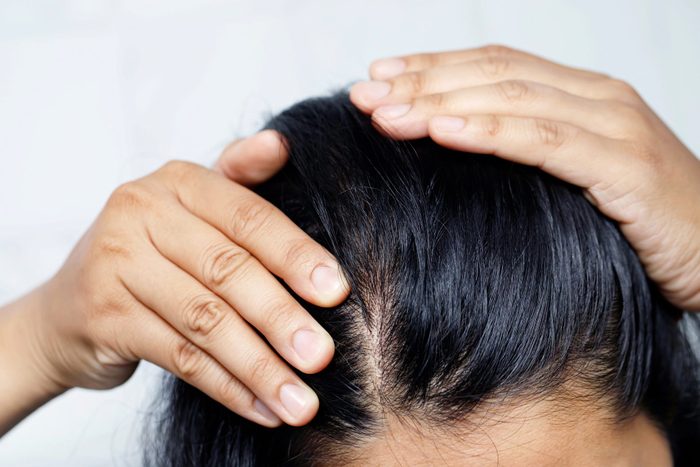 A woman with hair loss, she's allergic to shampoo and conditioner.