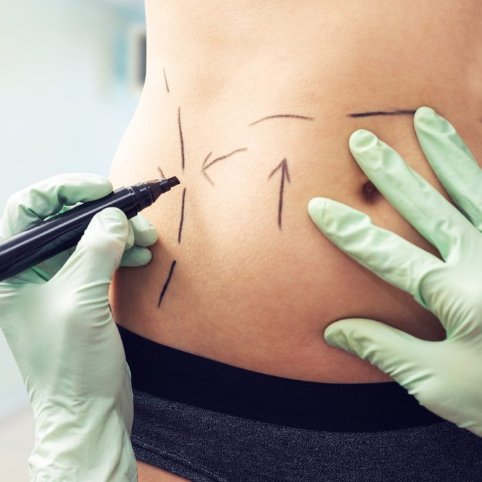 plastic surgeon marking womans body for surgery