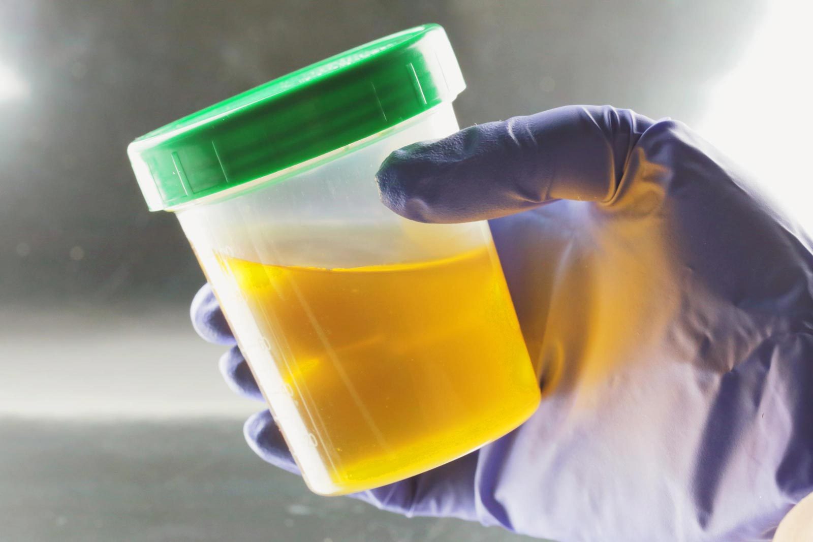 Expert Doctors: A Non-Invasive Urine Test Just “Changed the Game” for Prostate Screening