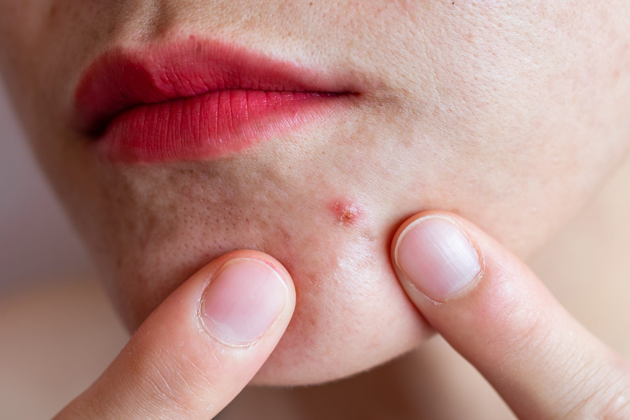 Cropped shot of woman pointing to acne occur on her lower face.