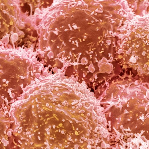 lung cancer cells