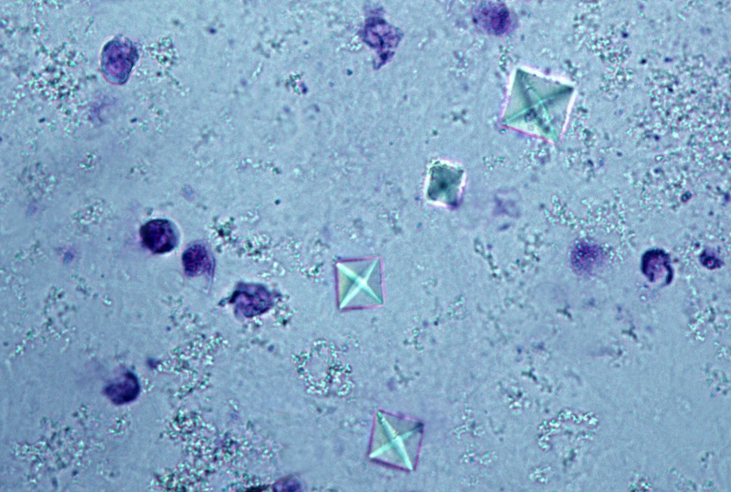 CALCIUM OXYLATE CRYSTALS IN URINE SEDIMENT, 200X