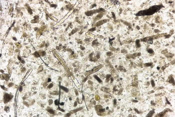 Microscopic urine examination showing Granular cast, a sign of many types of kidney diseases.