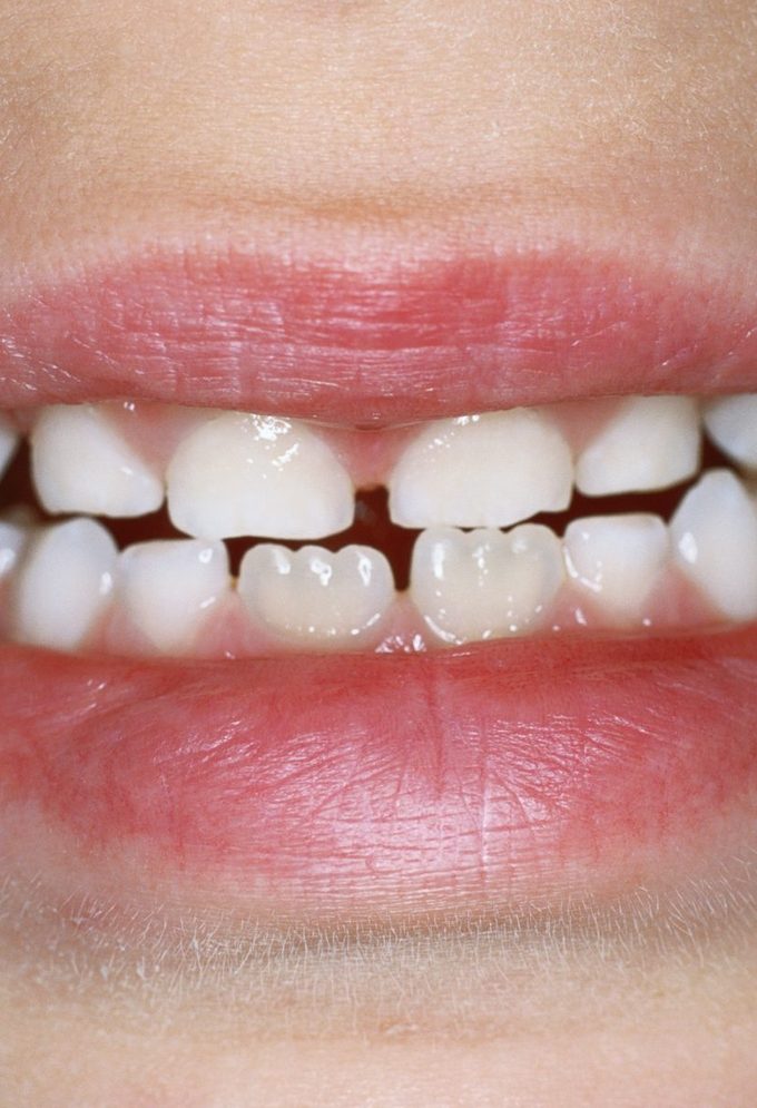 Mamelon Teeth Why You Have Ridges On Your Teeth Gettyimages Aa043016