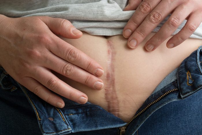 What I Wish I Knew About A Hysterectomy