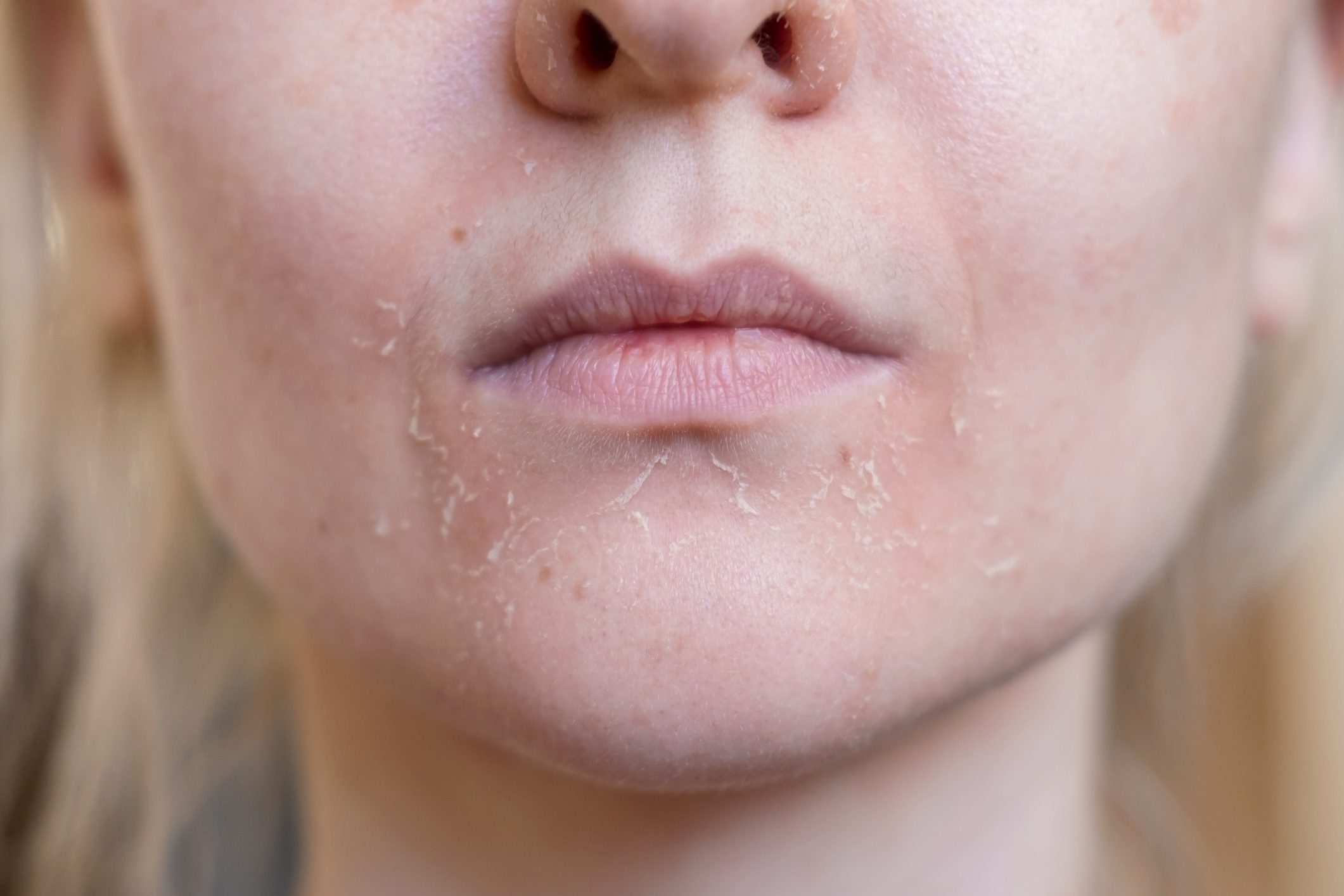 The woman skin flakes off at the mouth. Dry skin. Face skin irritation after peeling, after cold windy weather