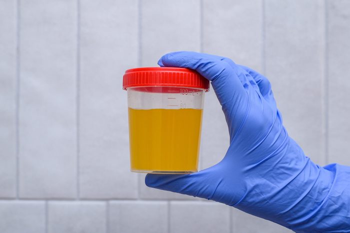 Hold plastic container with urine, cloudy dark urine