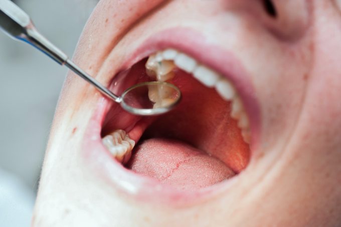 Black Spot On A Tooth