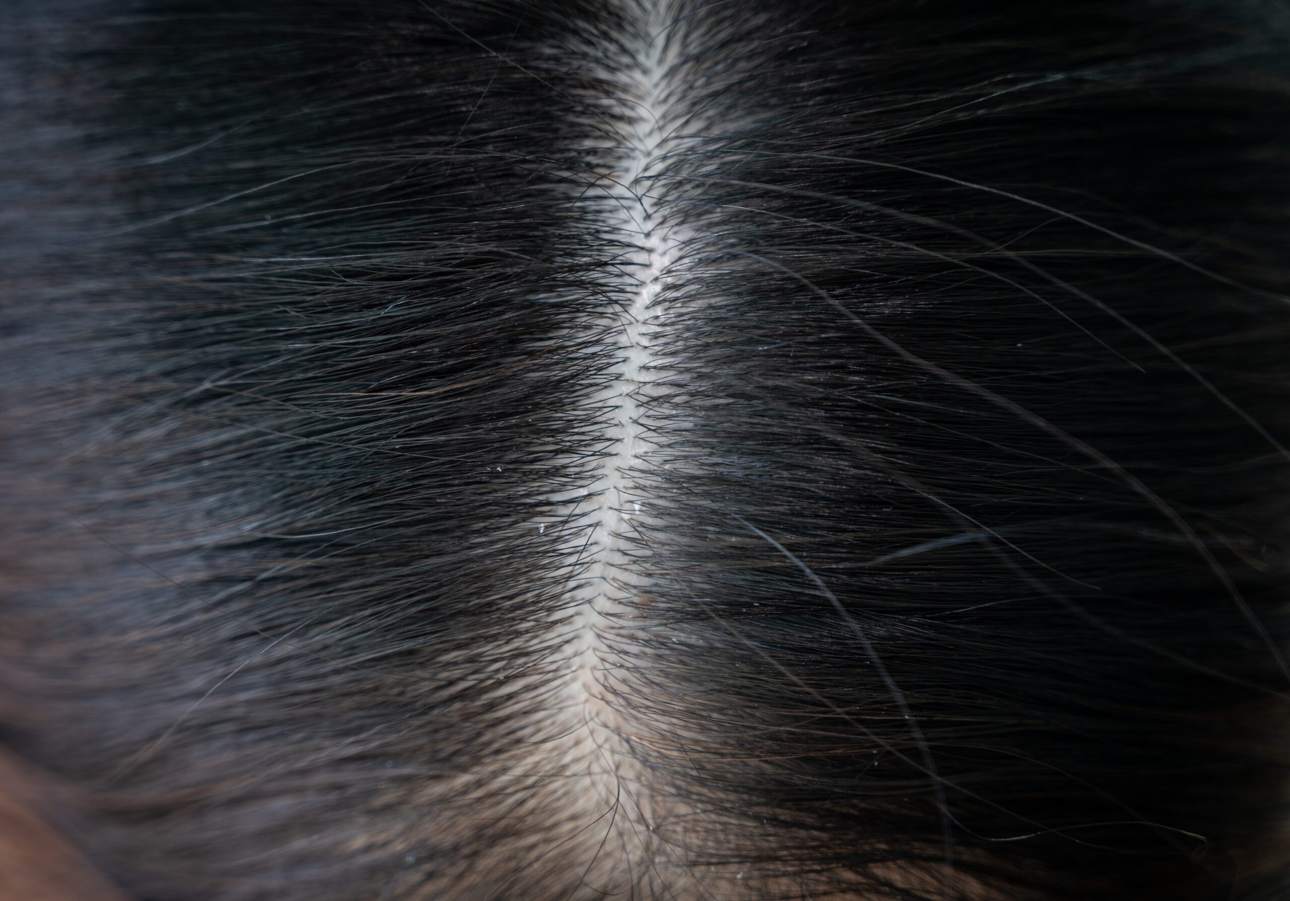 Dandruff vs. Dry Scalp: An Expert Doctor Explains the Difference