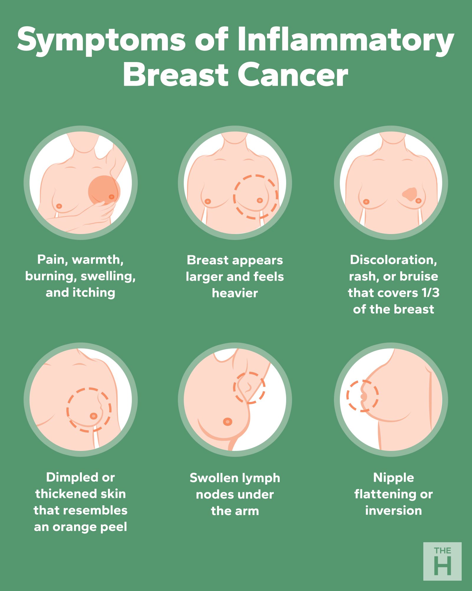 Symptoms Of Inflammatory Breast Cancer