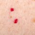 If You See Tiny Red Dots on Your Skin, Here's What It Means, Says a Dermatologist